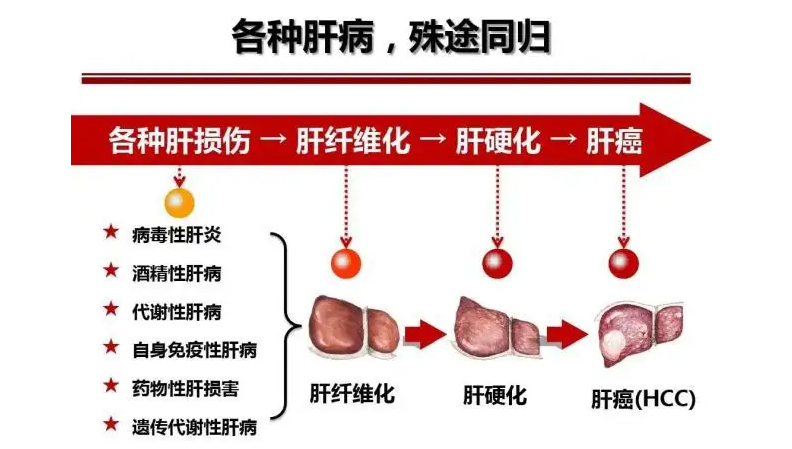 2022-03-18-袁方软文-爱肝日-图片2-肝纤维化有关疾病进展图.png